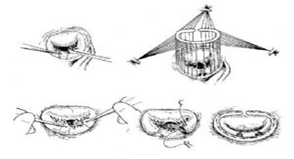 二尖瓣退行性病变的瓣膜成形_二尖瓣关闭不全_手术_病因 好大夫在线
