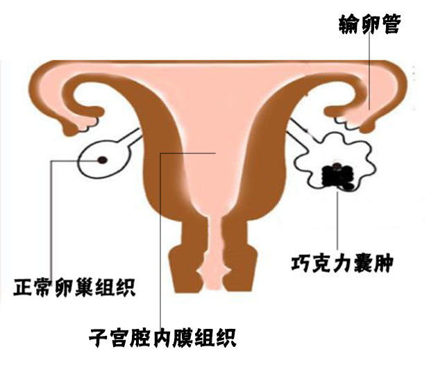 得了巧克力囊肿,建议尽早结婚并怀孕