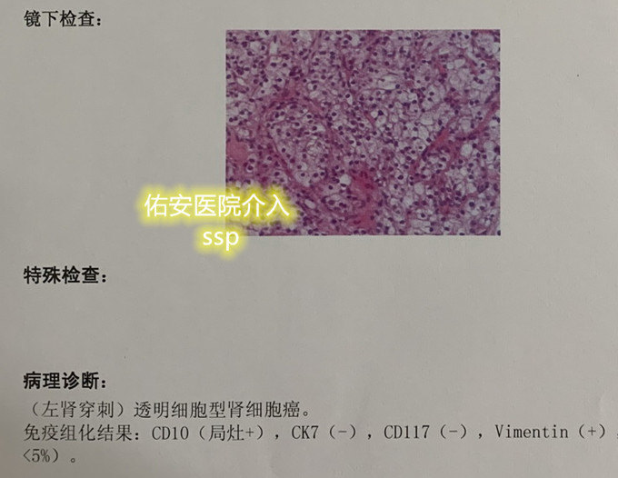 好大夫在线 生守鹏 > 早期肾癌的微创消融治疗 结语:早期实体 肿瘤