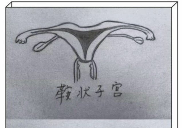 鞍形子宫:马鞍形子宫是由于副中肾管的尾端已大部融合,纵隔已退化.