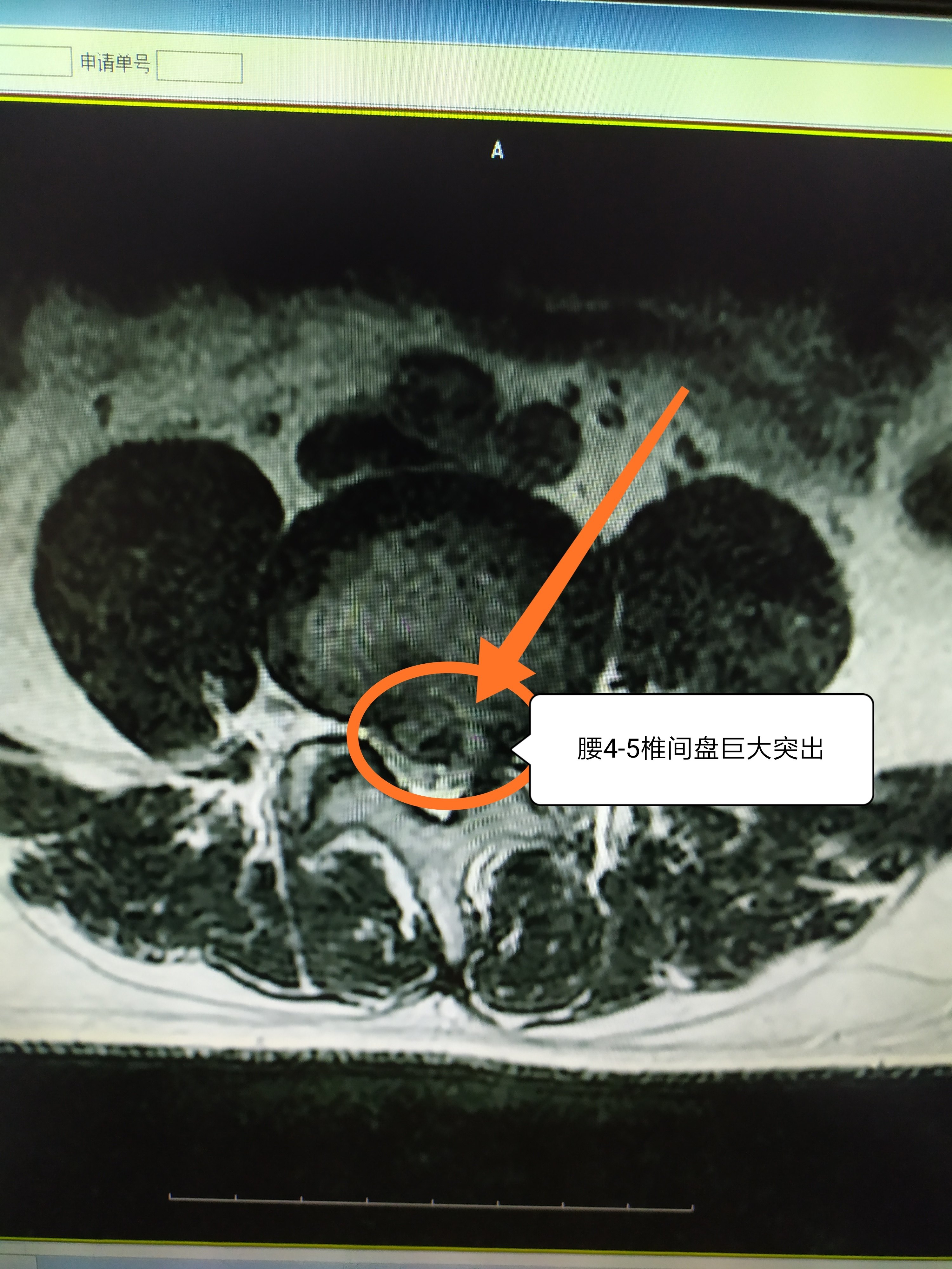 李明(化名),男,28岁,因为体检查腰椎ct或核磁(mri)发现腰椎间盘突出