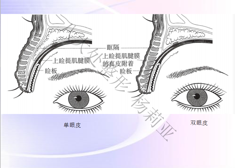 经过解剖上眼皮的结构发现:双眼皮的人上睑提肌腱膜是插到睑板前皮肤