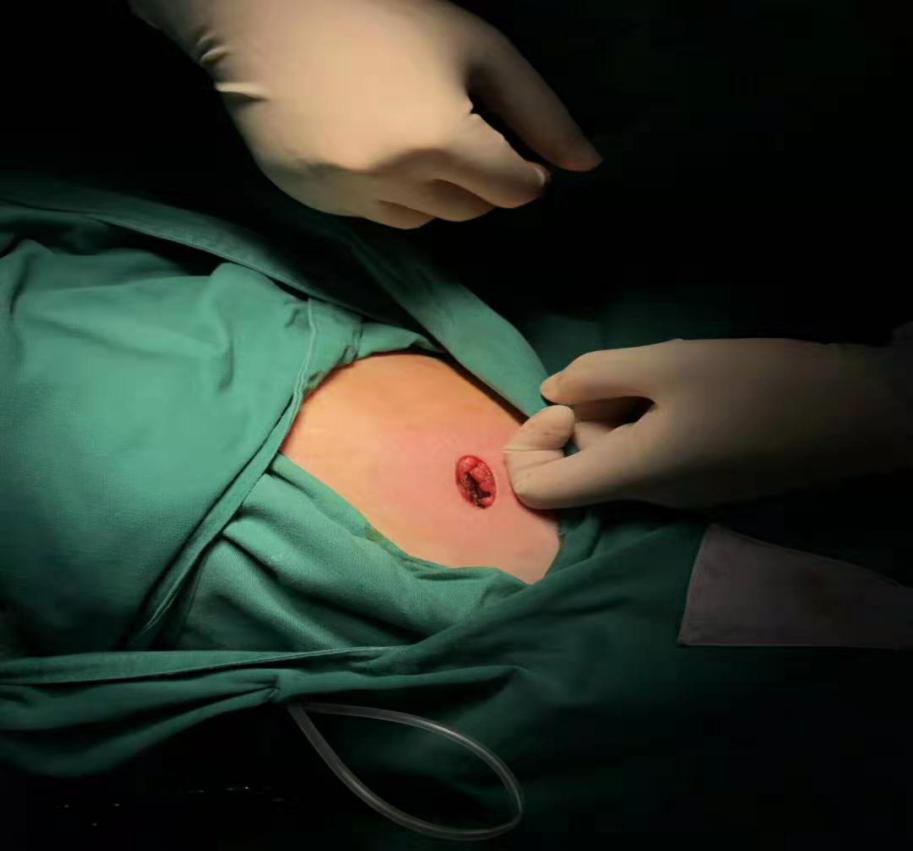 创伤最小的微创胸外科手术单孔胸腔镜手术