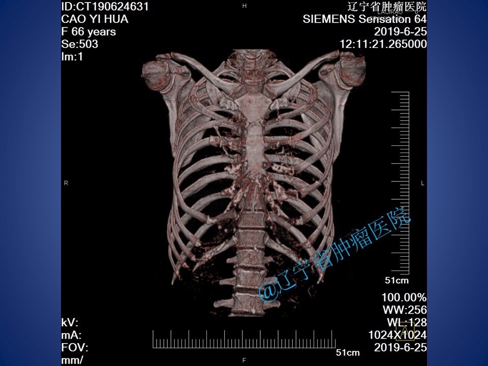 胸壁肋骨软骨肉瘤手术病例分享