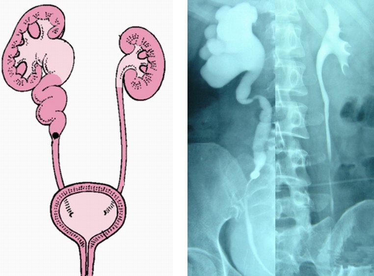 肾积水原因与治疗肾盂连接部狭窄腔静脉后输尿管输尿管癌