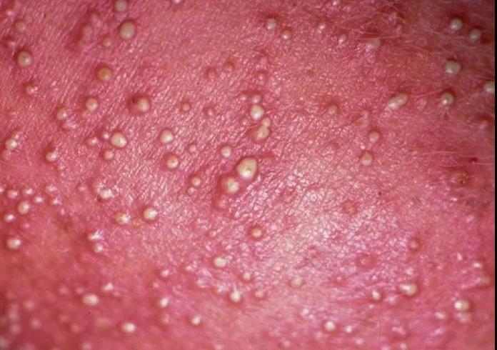 图7. 脓疱性粟粒疹