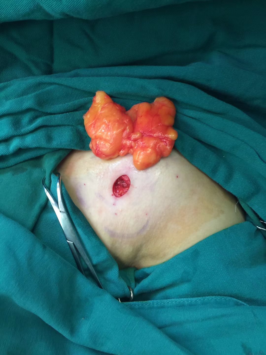 脂肪瘤的微创美容手术