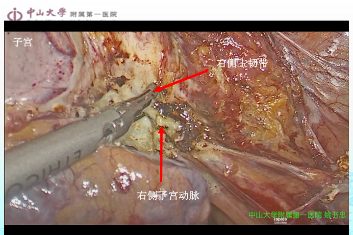 你应该了解的腹腔镜子宫切除术