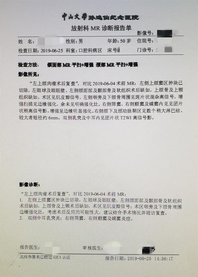 一例鼻咽癌放疗诱导的左上颌颅底骨肉瘤,较为棘手的病例