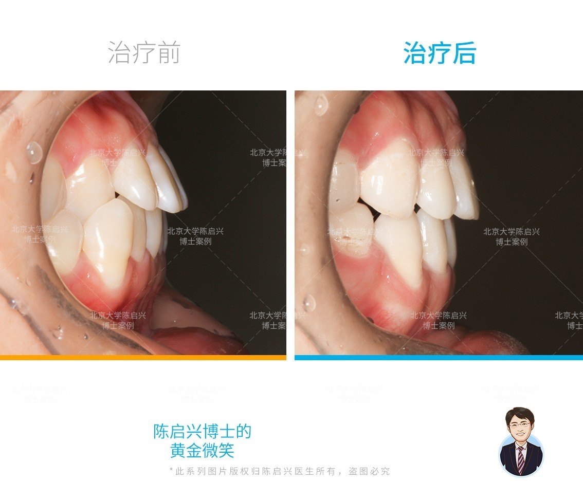 矫正前上唇凹陷,牙列不齐,笑容太假,矫正后的她笑弧打开,十分完美.