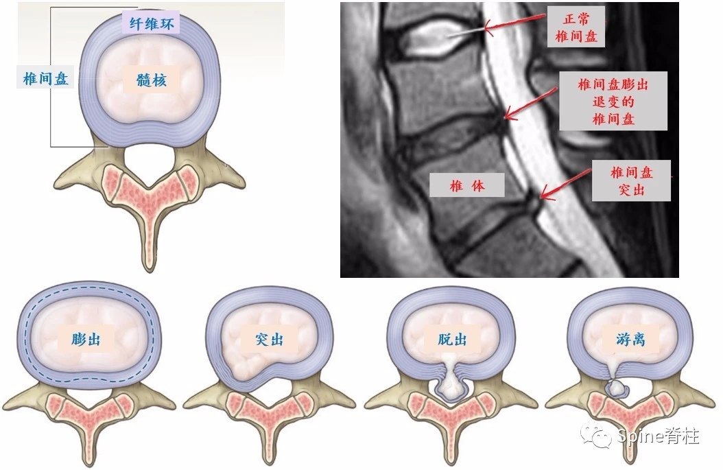 腰椎间盘突出症常见误区(三)腰椎间盘突出=腰椎间盘突出症