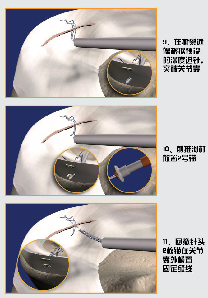 半月板缝合全内allinside技术解读