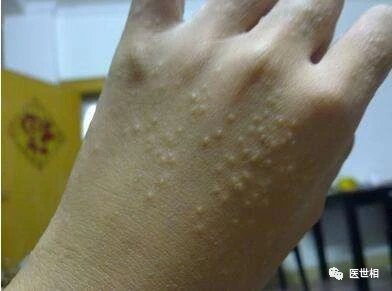 这个夏季高发病让手指长满小水泡,到底是水痘还是湿疹
