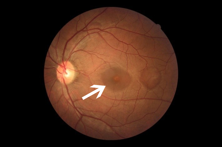 黄斑裂孔(全层) 这个病就是老百姓说的"眼底有个眼儿"或"视网膜膜裂了