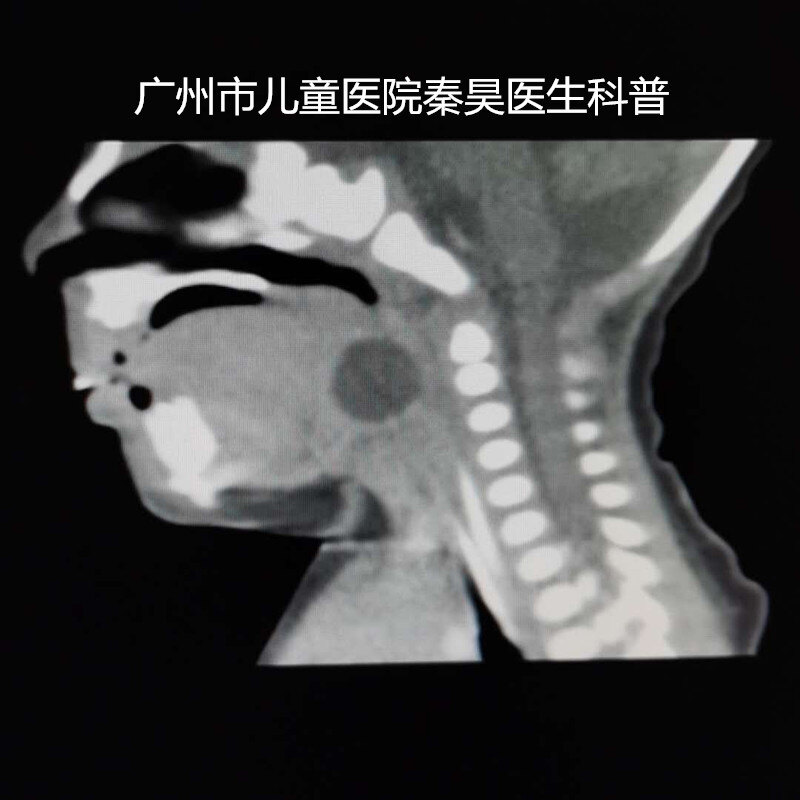 婴幼儿舌根会厌囊肿的微创治疗