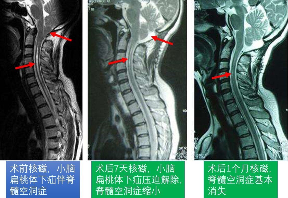 脊髓空洞症:你最需要搞清楚的几件事