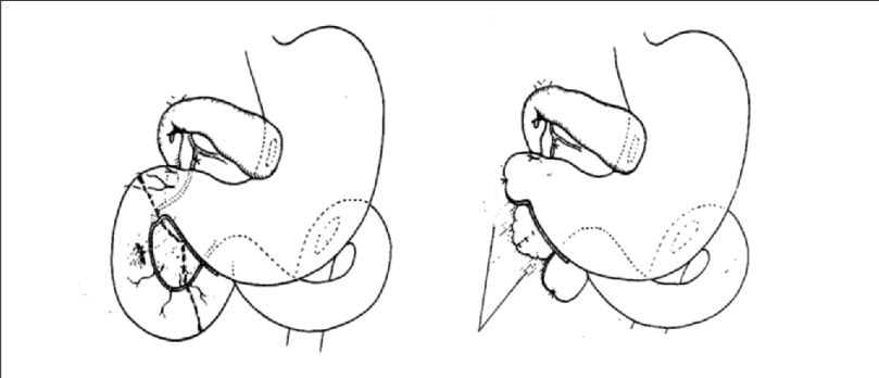 whipple第二阶段手术.png