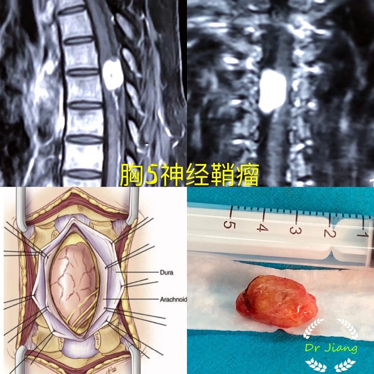 警惕不一样的腰腿痛椎管内常见肿瘤