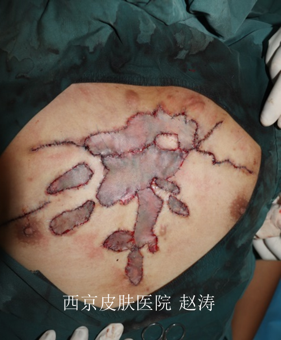 前胸瘢痕疙瘩案例1手术切除刃厚皮片移植联合放疗