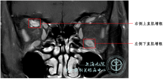 graves眼病系列病例⑦斜视矫正术