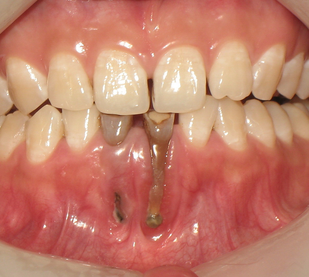 牙龈萎缩与牙槽骨破坏的关系牙周健康的原理1
