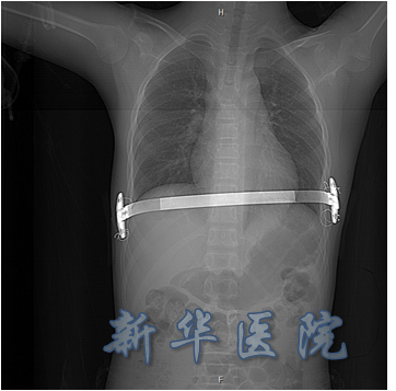 哪些鸡胸患者适合微创手术微创鸡胸手术是怎么做的