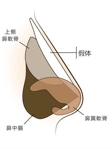 是两个完全不同的解剖范围,严格来说,有鼻炎的仙女是可以做隆鼻手术的