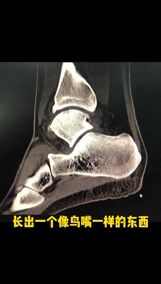 前踝关节撞击综合征