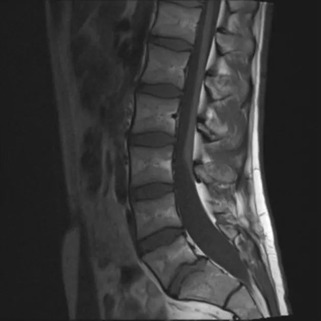 脊髓栓系综合征患者典型病例分析