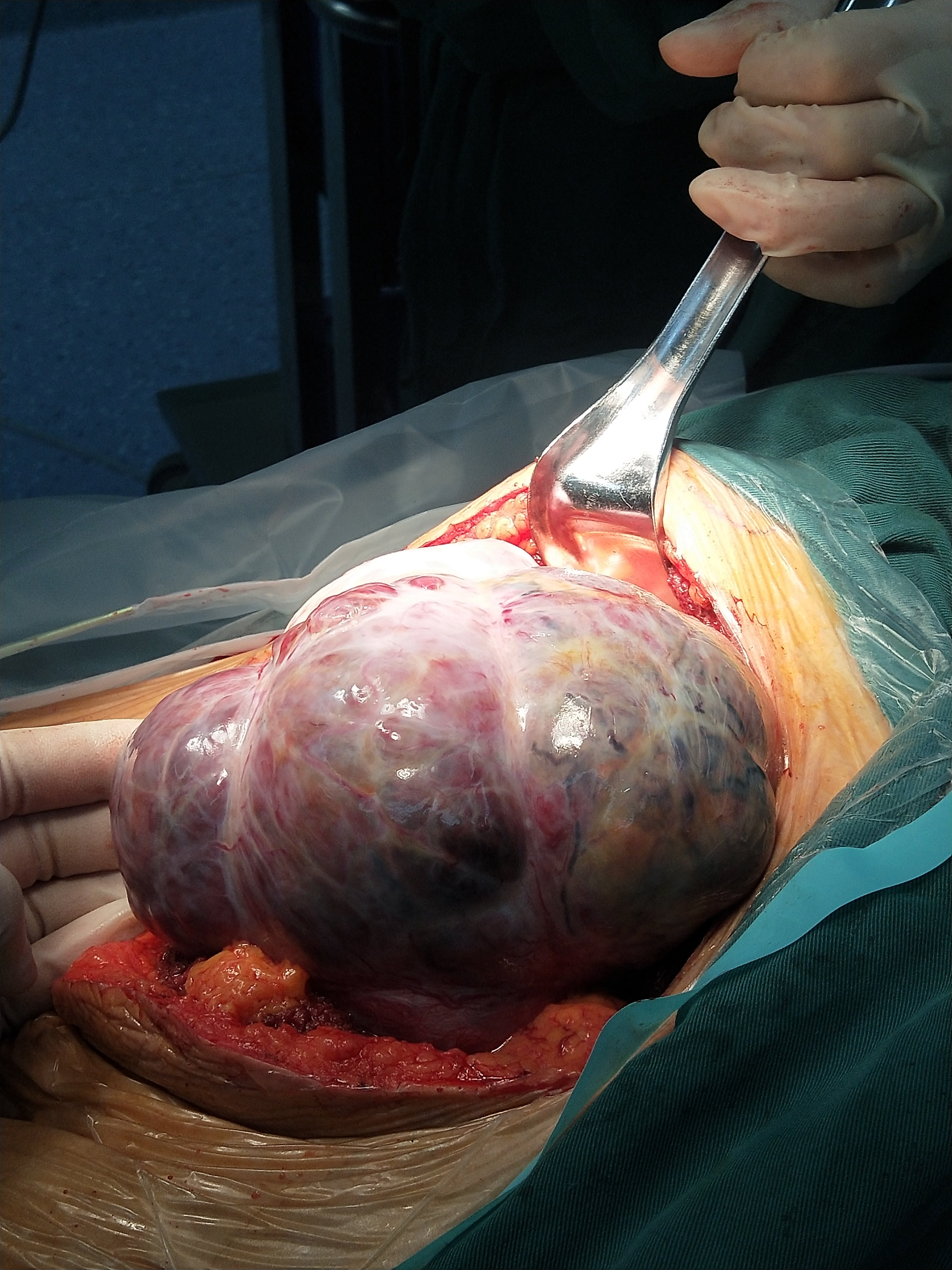 十二指肠巨大间质瘤一例