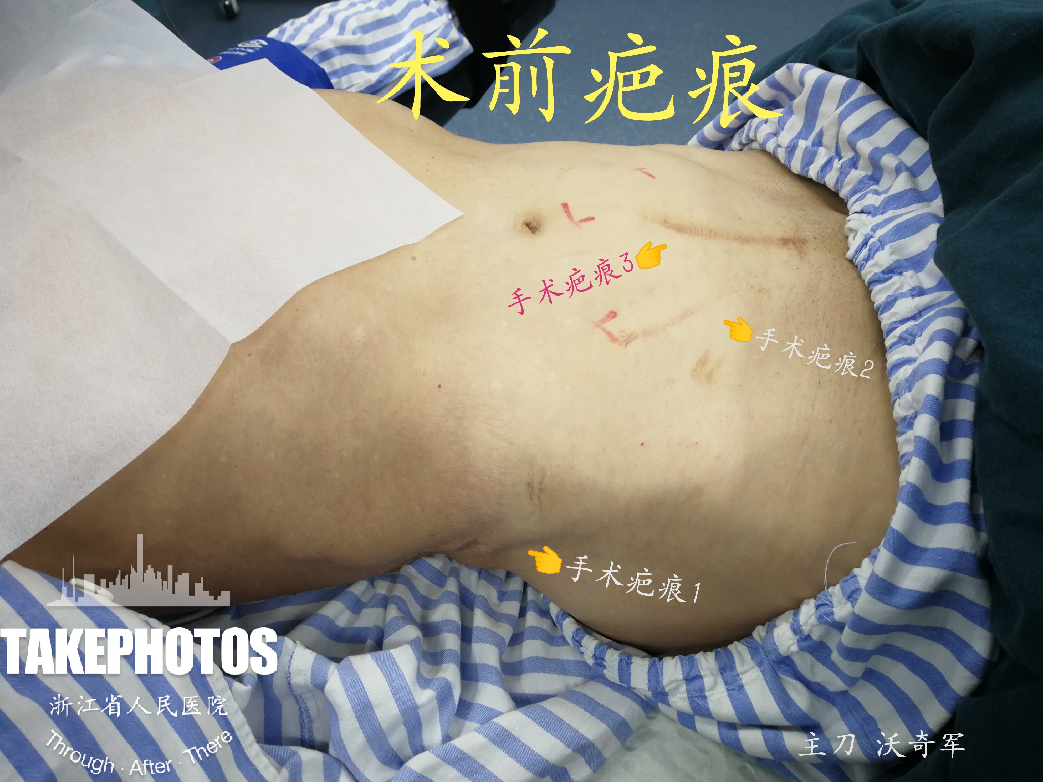 沃医生主刀手术1:腹腔镜膀胱癌根治术