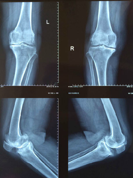 大夫个人网站 >  文章列表 > 文章详情   以下为患者术前膝关节x片:双