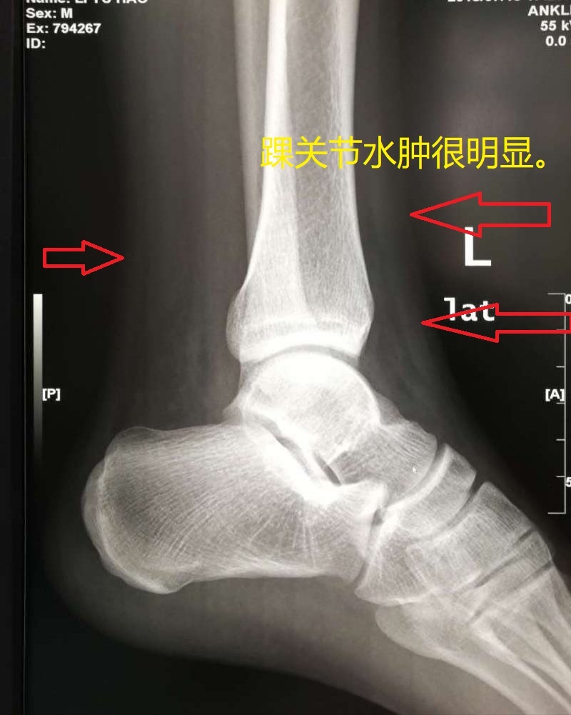 崴伤脚两天,内侧外侧皆浮肿有淤青能走路 运动崴脚.