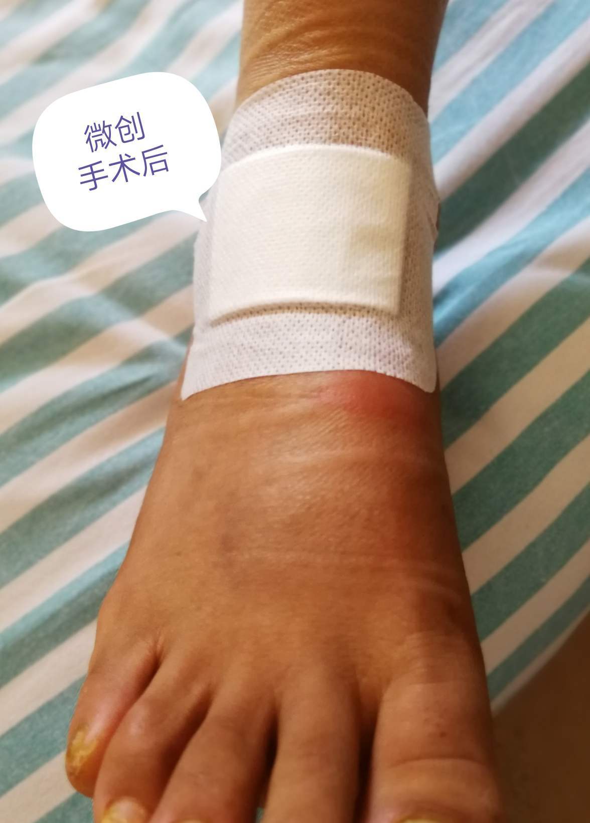 脚踝扭伤(崴伤)踝关节疼痛,容易被遗忘的角落(附2病例