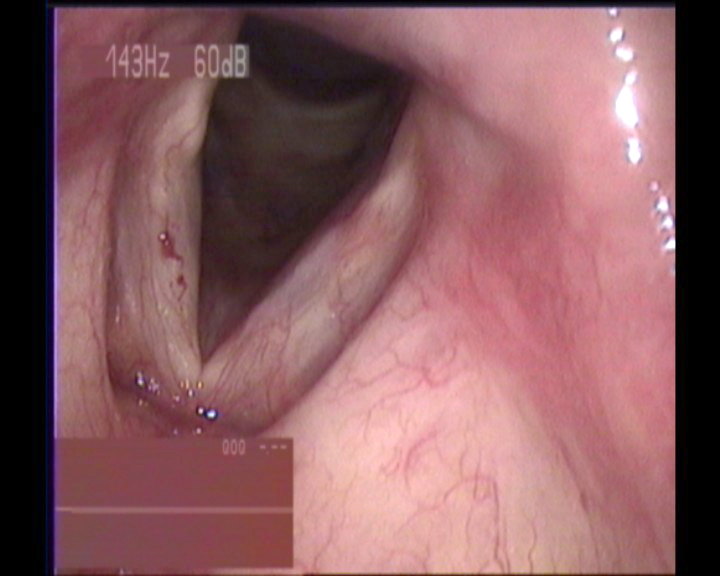 用嗓过度后失声3天,双声带肥厚,血管增生扩张,右侧声带有血管破裂样