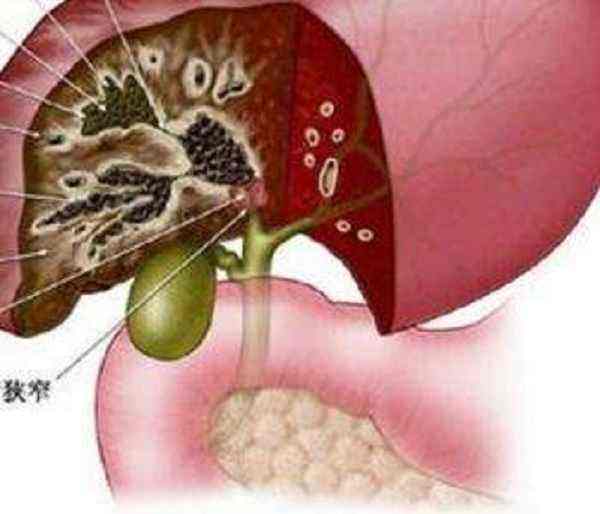重视肝内胆管结石并发胆管癌的诊治