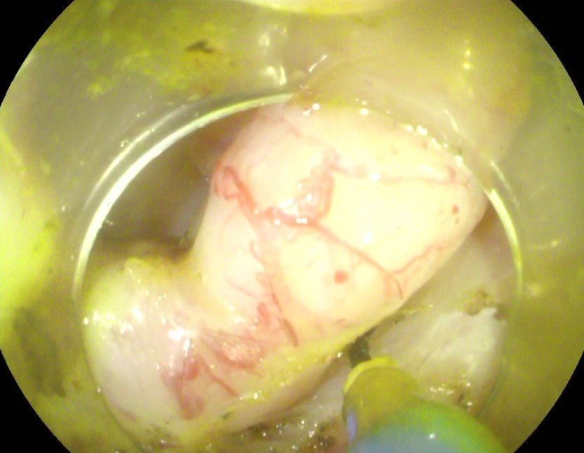 经肠镜逆行阑尾切除术