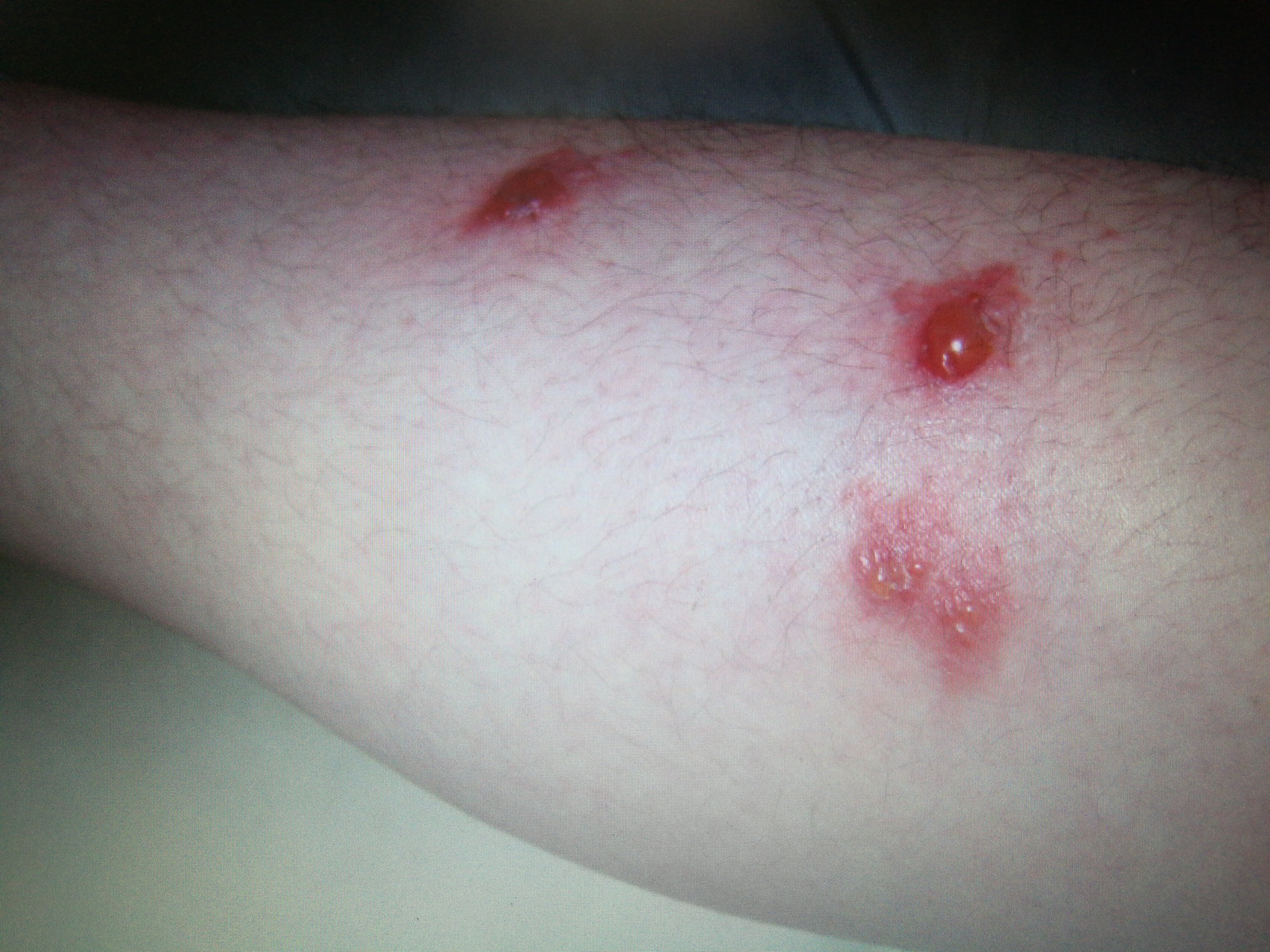 小腿散在的红色丘疹,丘疱疹.