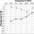 听力测试(听力图,检查传导性听力损失.