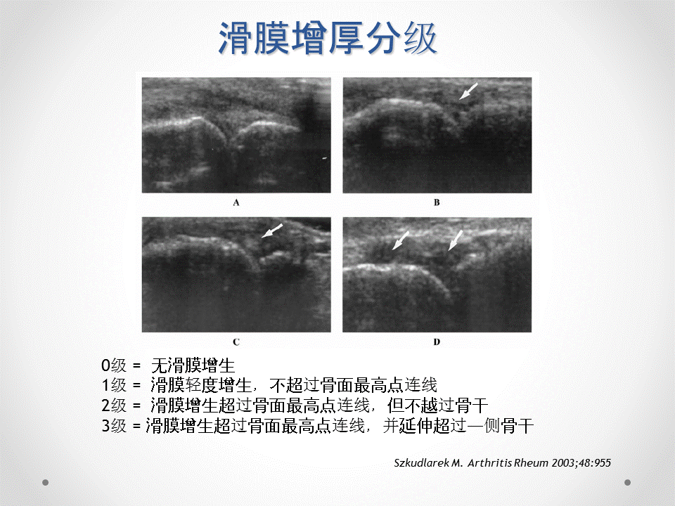 肌骨关节超声帮你找出潜伏亚临床滑膜炎