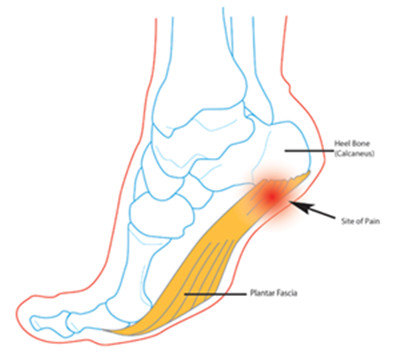 得了跟痛症(跖筋膜炎)怎么办?