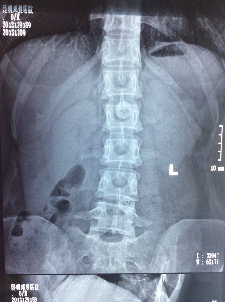 颈椎病导致上肢无力疼痛呼吸困难,祖传手法2周