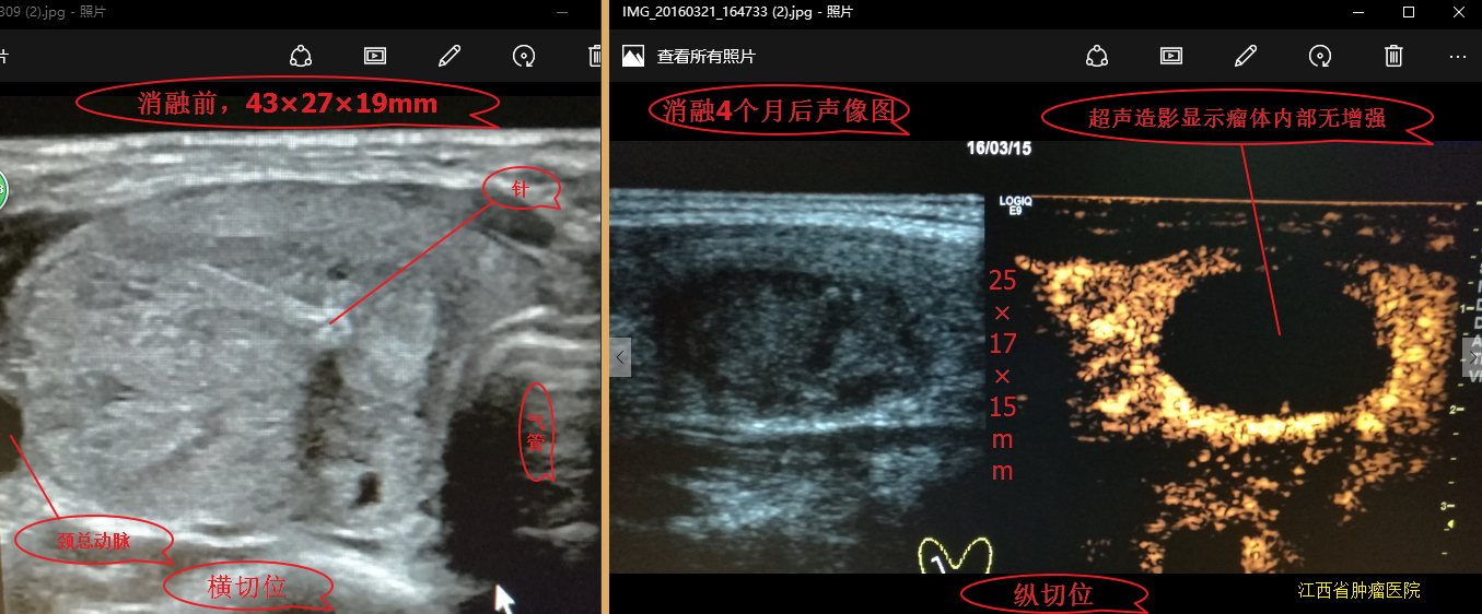 甲状腺结节微波消融术后,随访效果图! - 好大夫