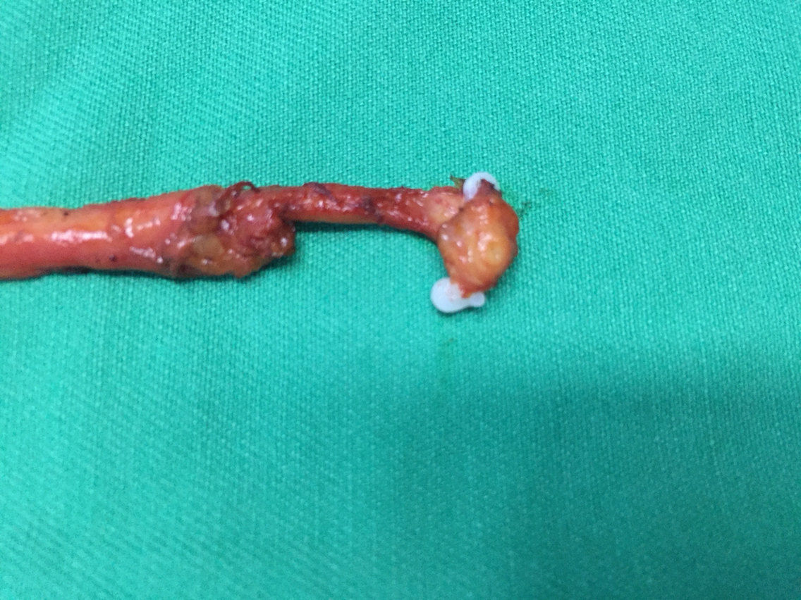 完全腹腔镜下肾、输尿管全长切除术