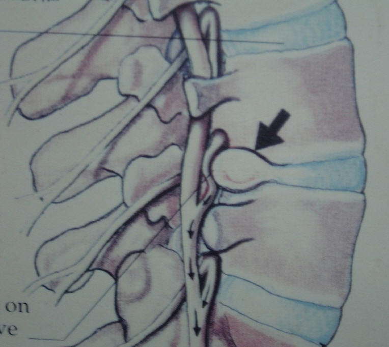 腰椎侧隐窝性疼痛解剖,病因与诊治
