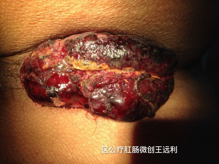 混合痔手术
