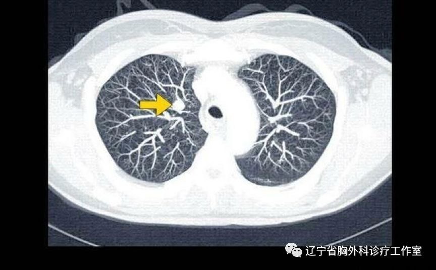 肺结节与肺癌