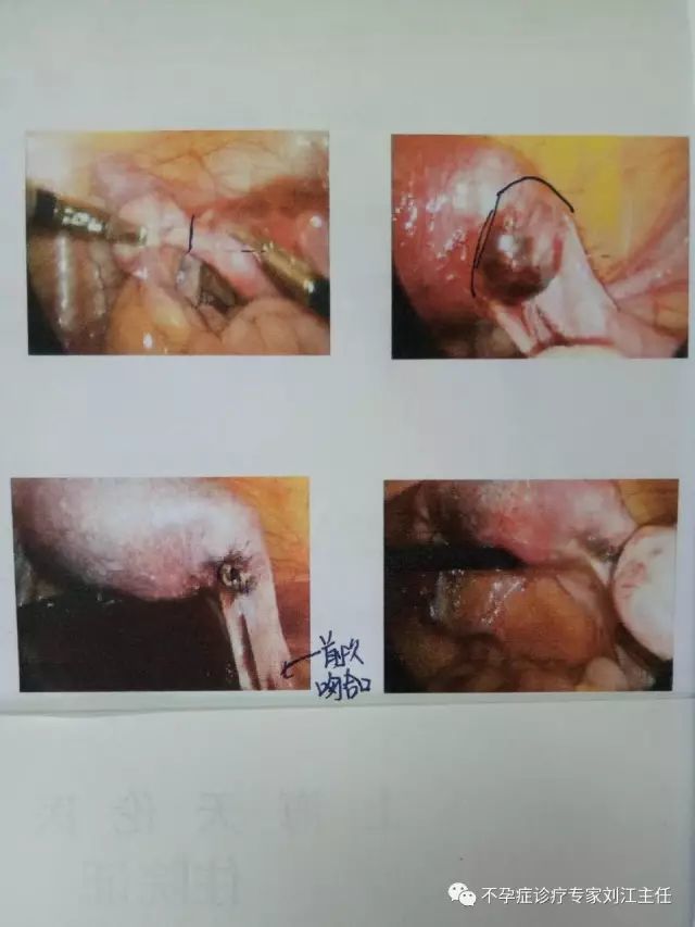 宫外孕输卵管切还是不切?