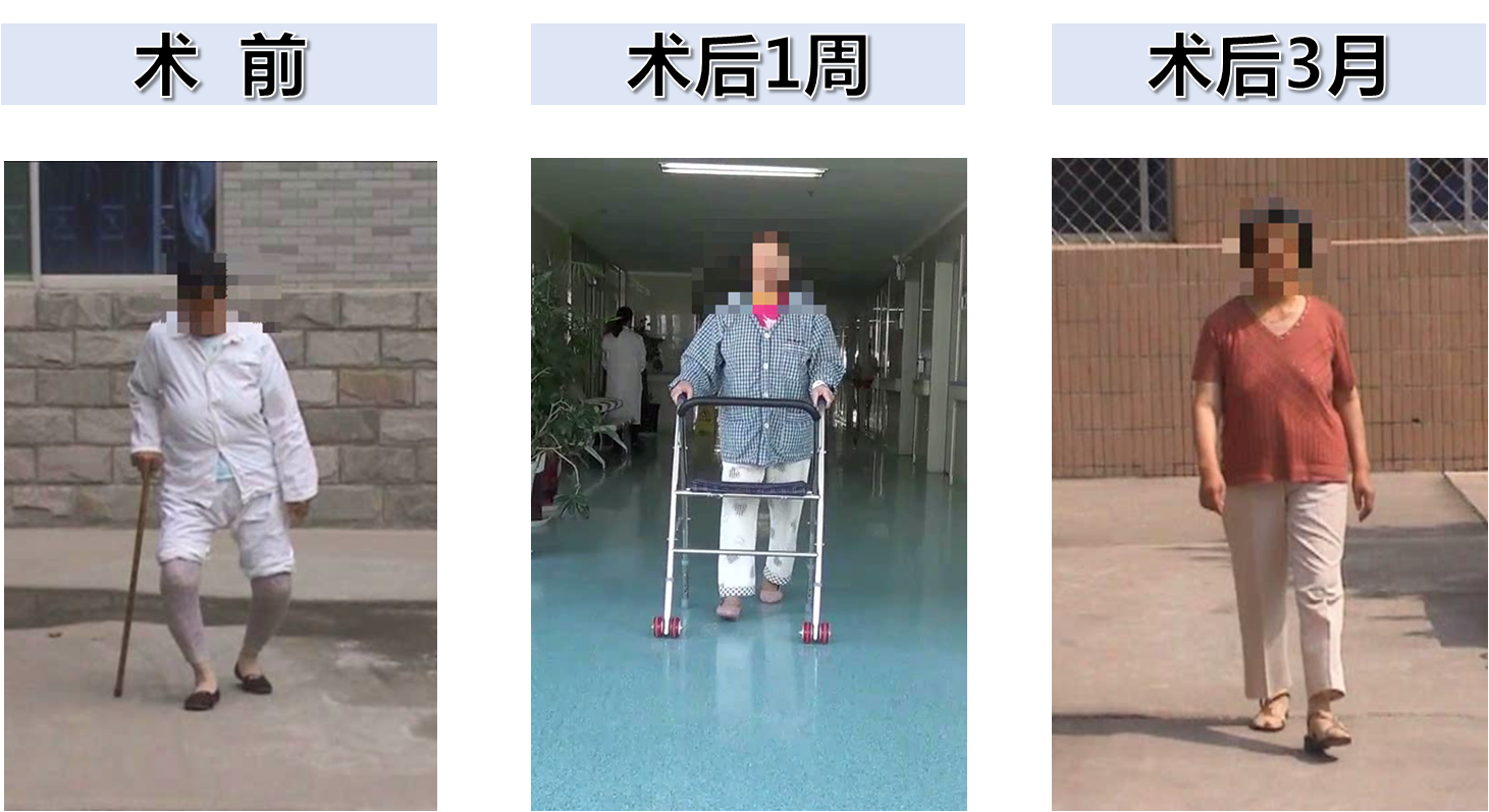 膝关节置换患者术后1日就可下地,术后1周患者就可在助行器辅助下自如