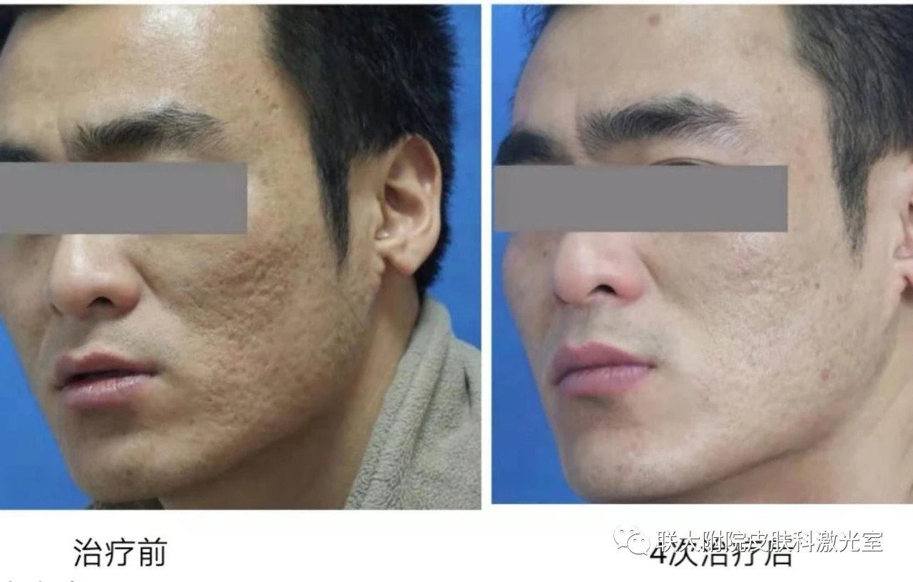 点阵激光         剥脱性点阵激光进行皮肤重建,从而填充凹陷性痘坑